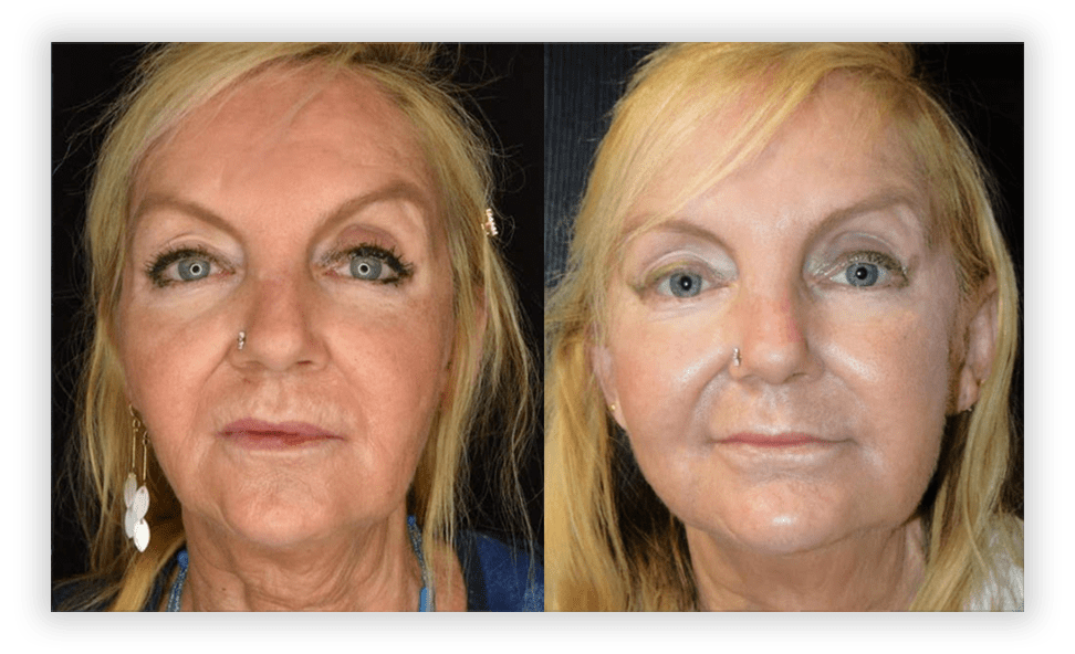 Before & After Non-Surgical Cosmetic Treatments - Greater Toronto