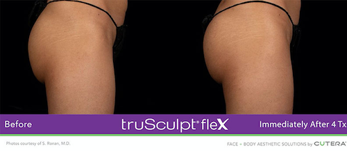 truSculpt® flex – truSculpt® flex in Toronto & Mississauga