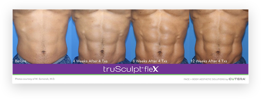 Start TruSculpt Body Contouring Now for the Shape You've Always Wanted by  Summer: Dermatology of Boca: Dermatologists