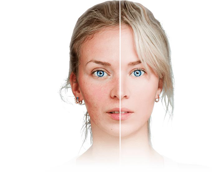 Active Acne