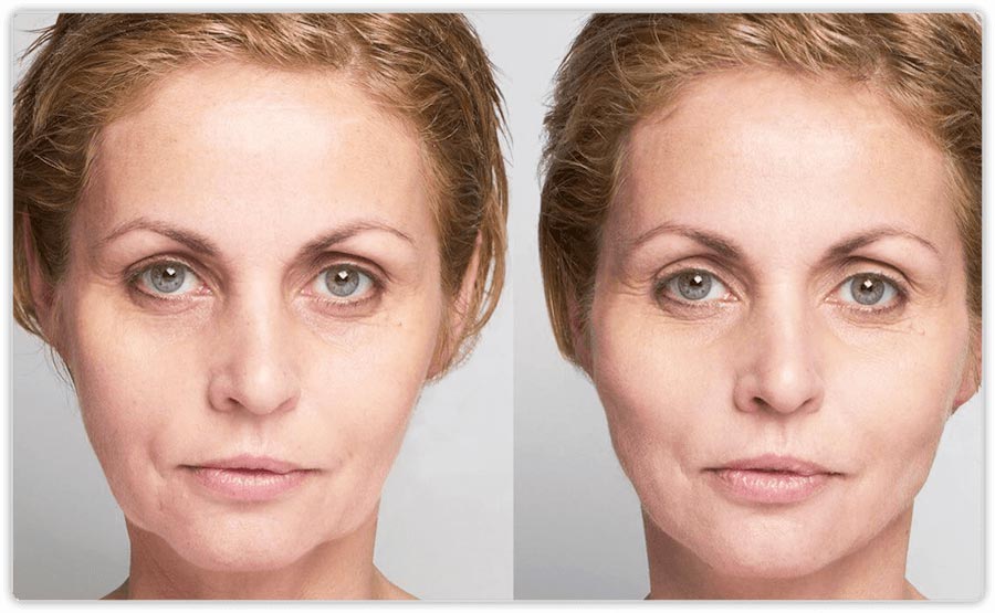 Before and After Treatment, Thread Lifts