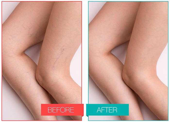Spider Veins Treatment