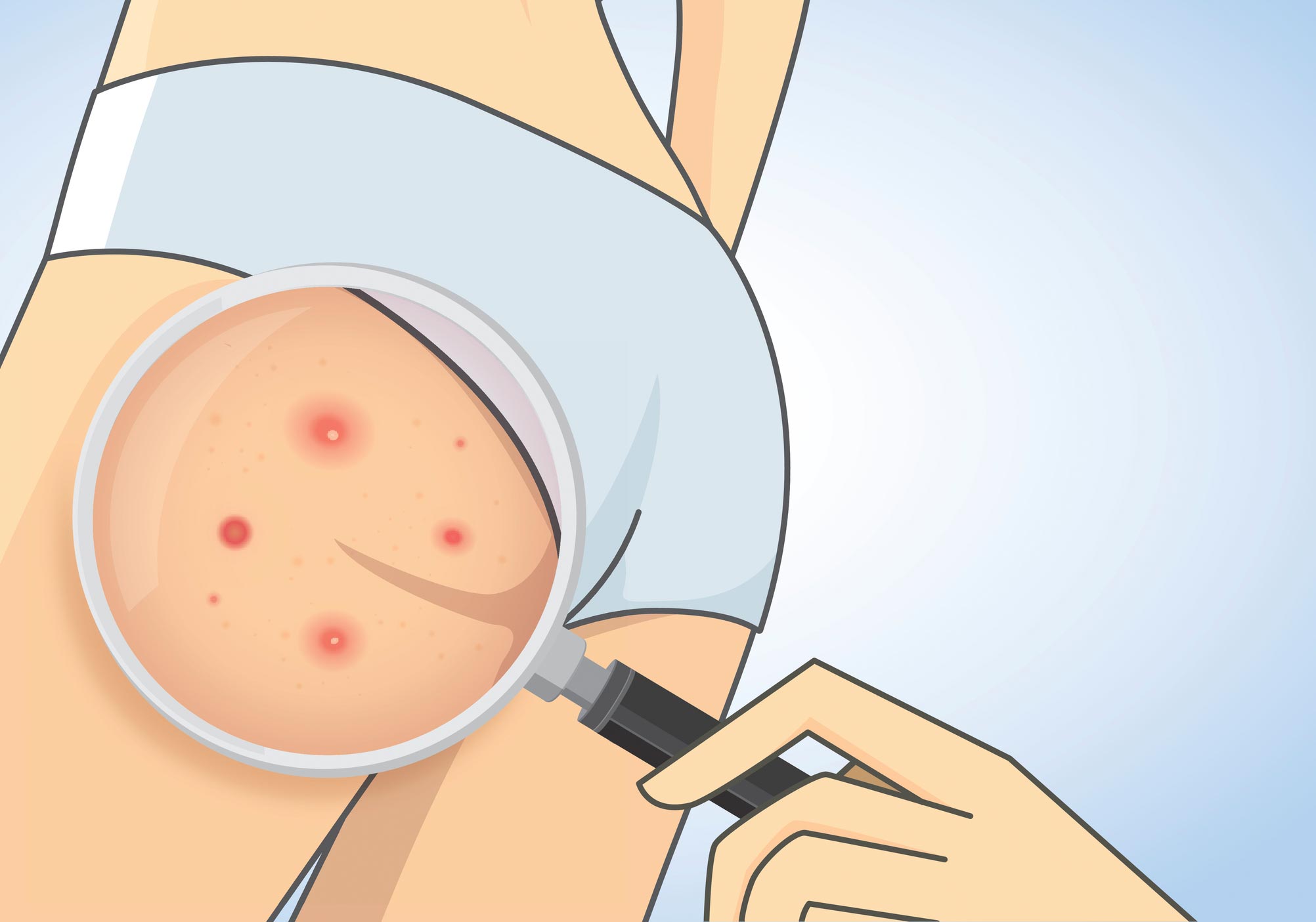 Butt Acne Treatment