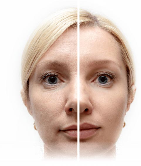 Dermal Fillers