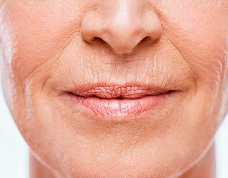 Lip Fillers