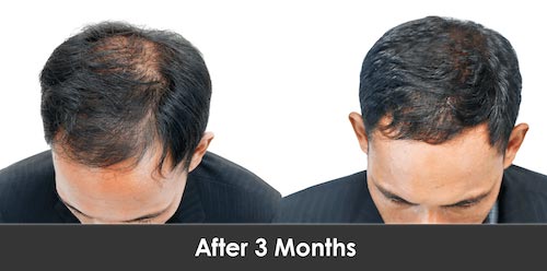 Hair Restoration