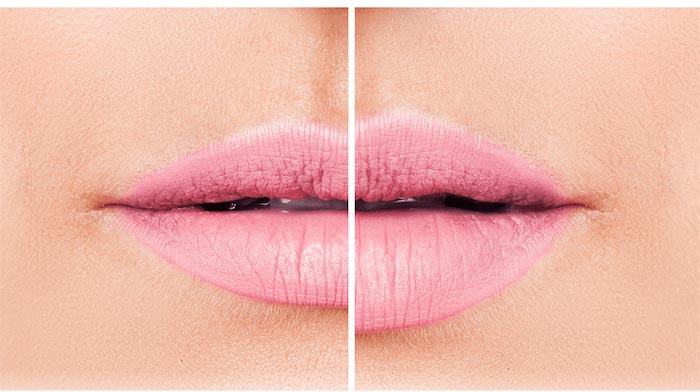 Before and after Lip Fillers