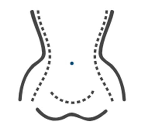 Stretch Marks, Excessive Sweating Treatment - Hyperhidrosis