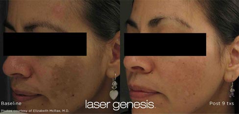 Laser Genesis