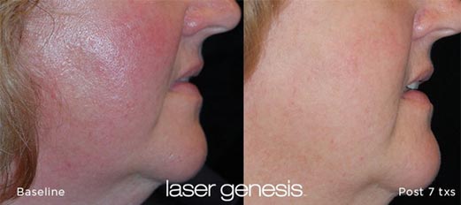 Laser Genesis