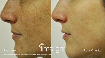 Advanced Facials