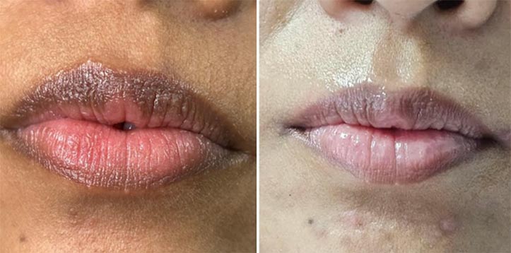 Lip Fillers