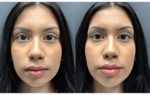 Lip Fillers