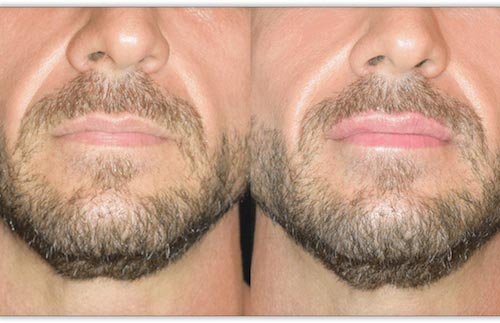 Lip Fillers