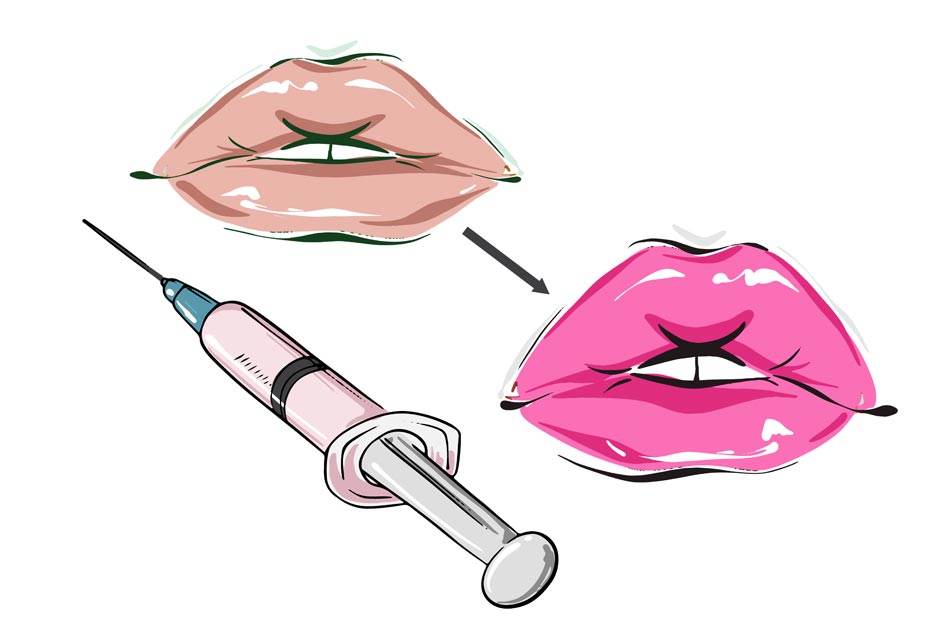 Lip Fillers