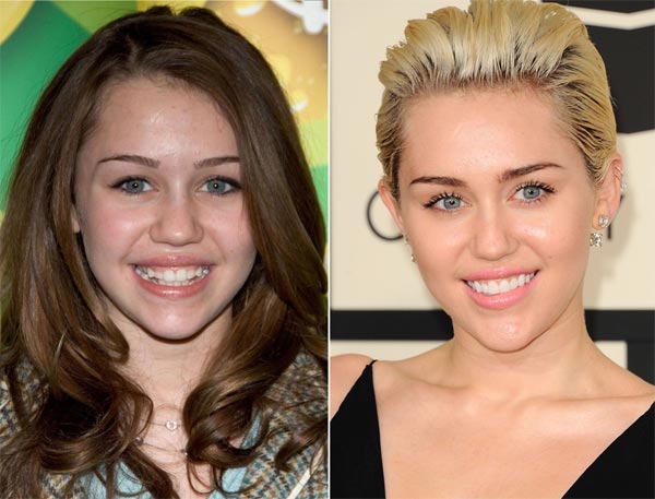 Lip Fillers
