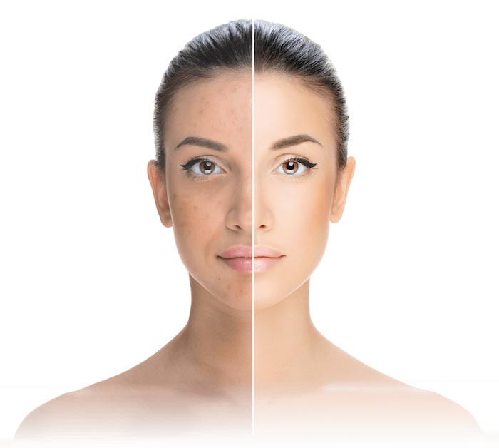 Non-Surgical Facelift