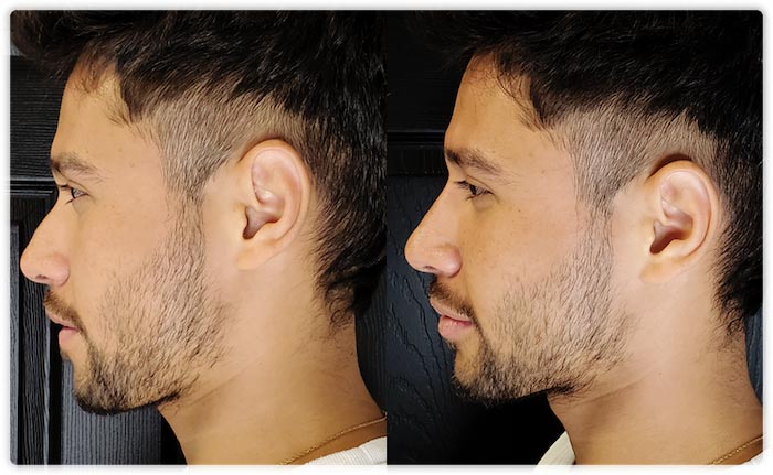 Non-surgical Nose Jobs