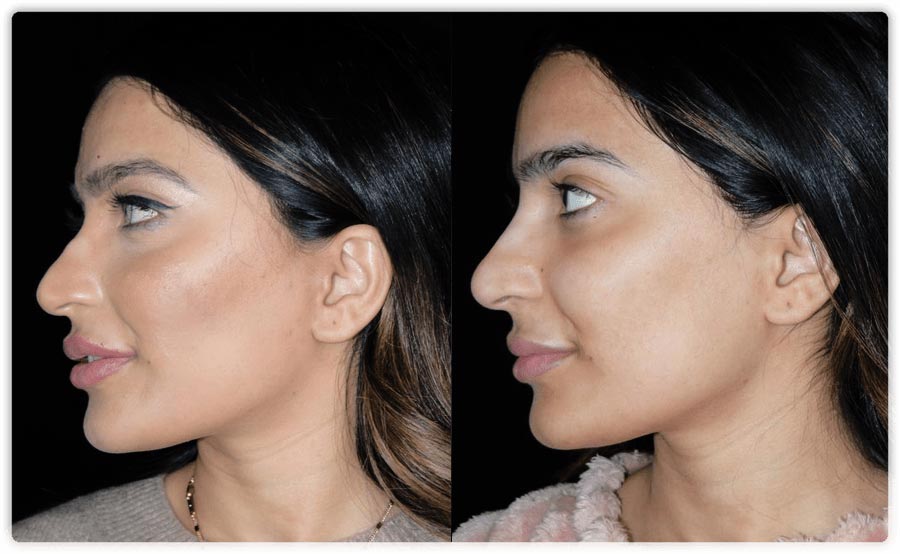 Non-surgical Nose Jobs