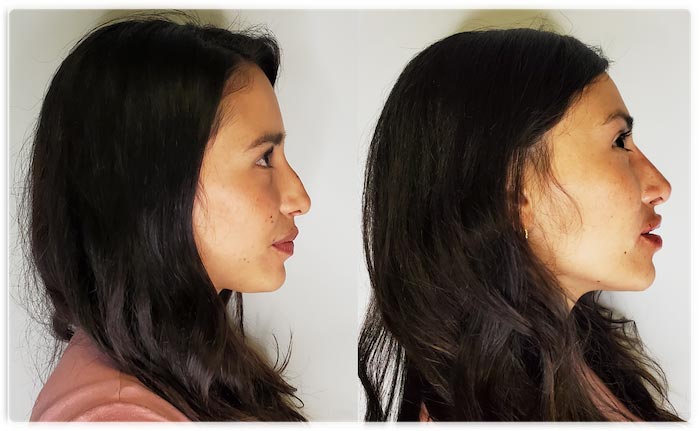 Non-surgical Nose Jobs