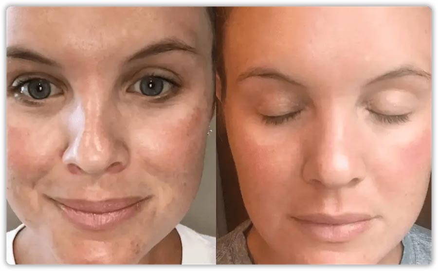 PRP Face lift