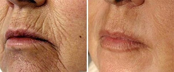 Lip Fillers