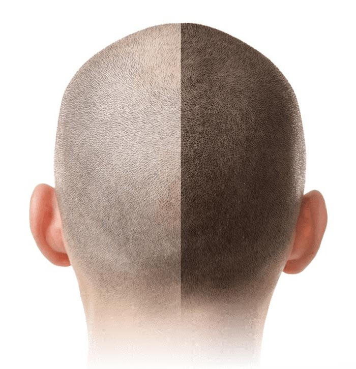 Scalp Pigmentation
