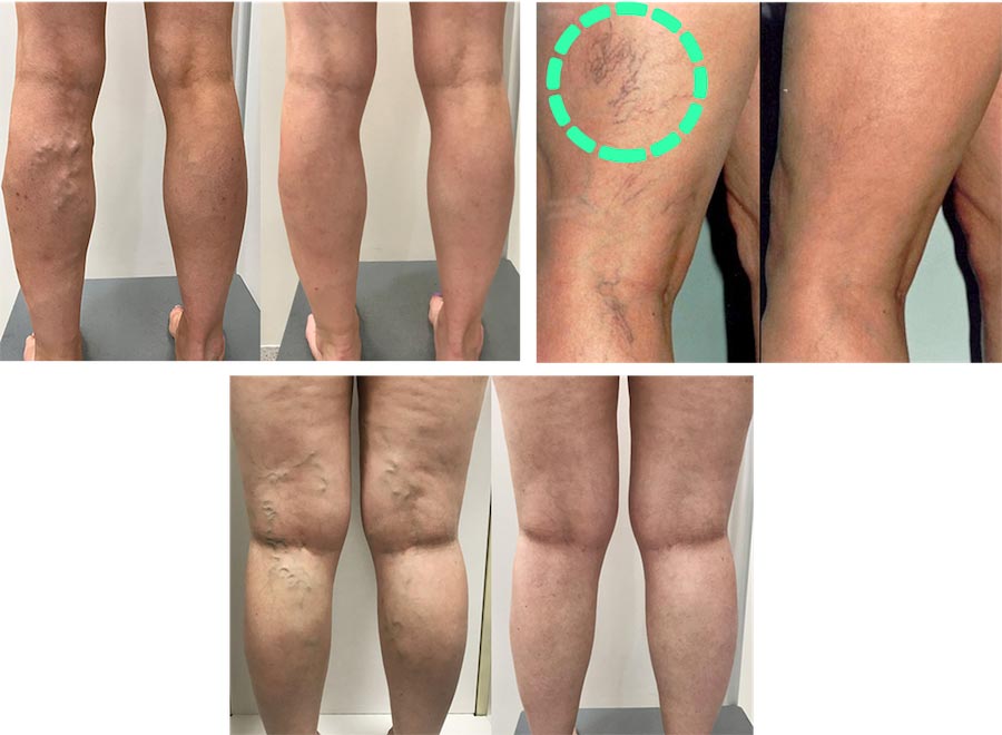 Sclerotherapy