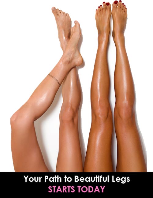 Spider and Vericose Vein Treatments