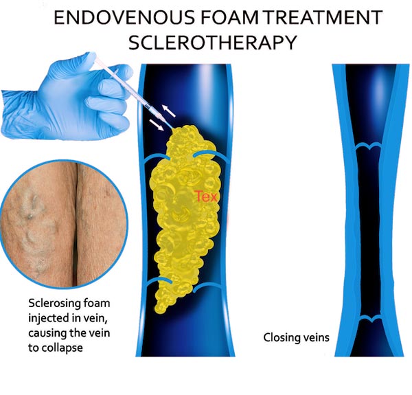 Sclerotherapy