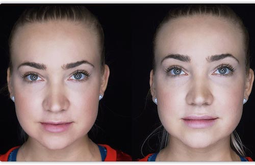 Lip Fillers