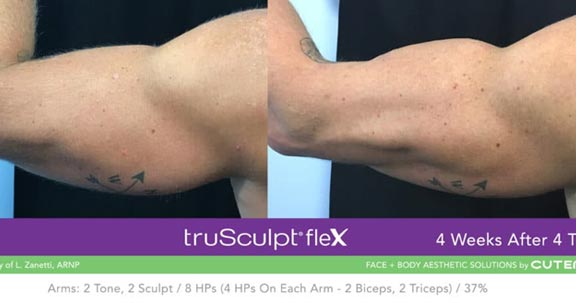 Arm Contouring