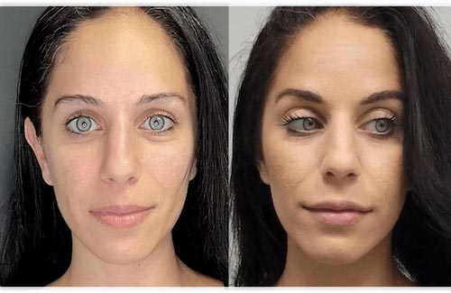 Lip Fillers