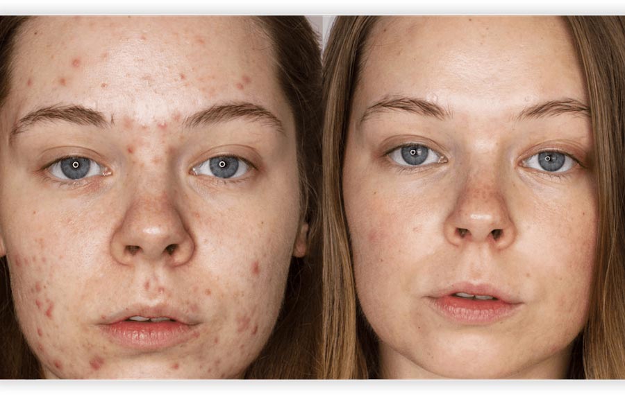 Active Acne