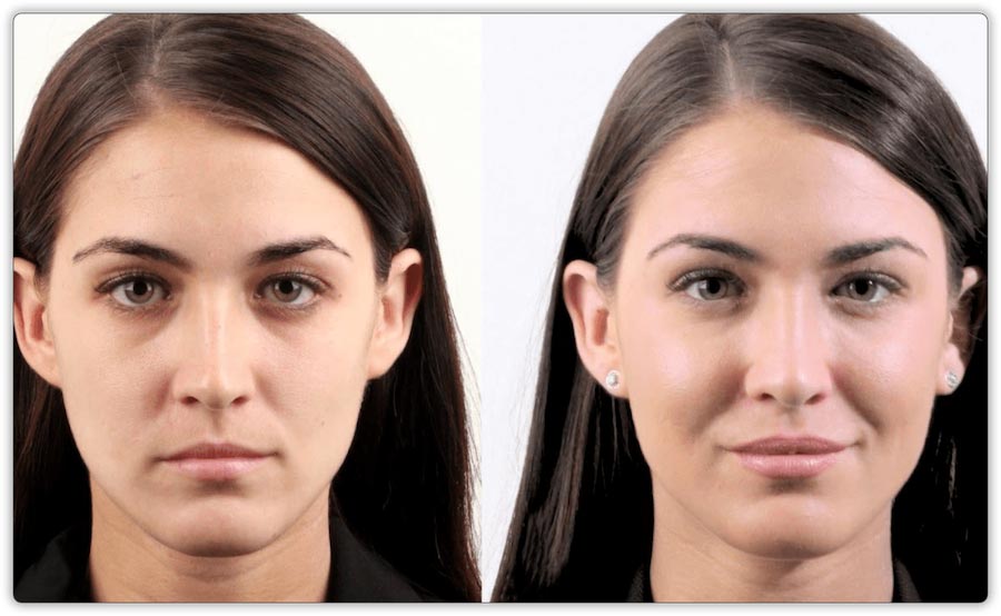 Dermal Fillers