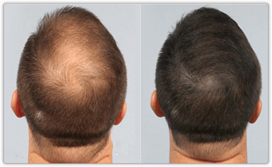 Hair Restoration
