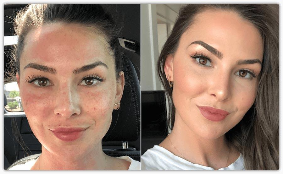 PRP Treatments & Micro-needling