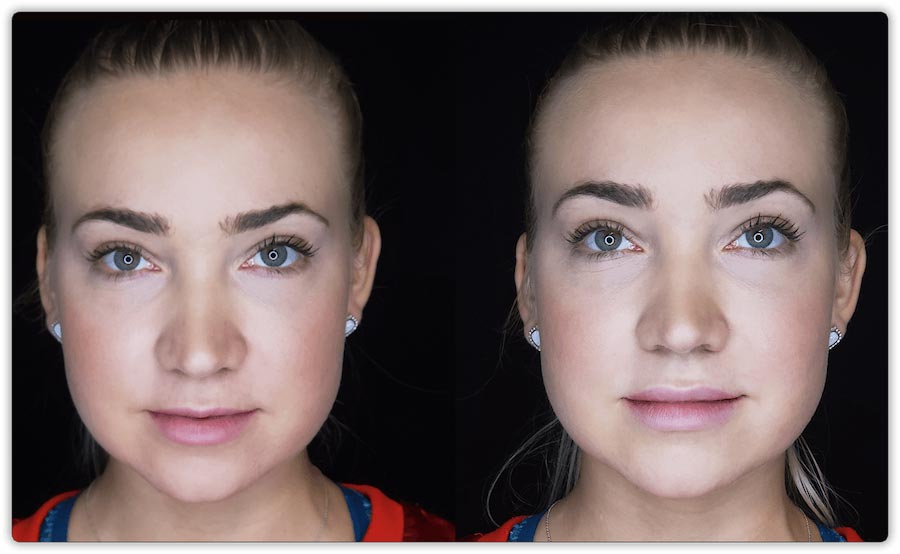 Before and after Lip Fillers