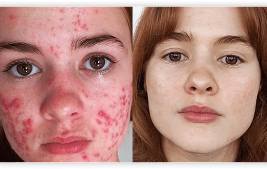 Active Acne