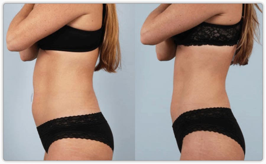 Eliminating Body Fat