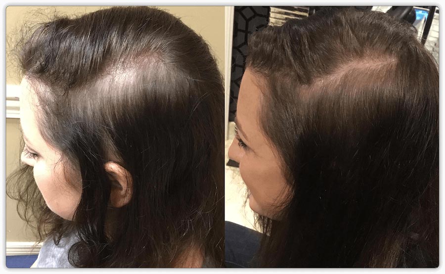 Hair Restoration