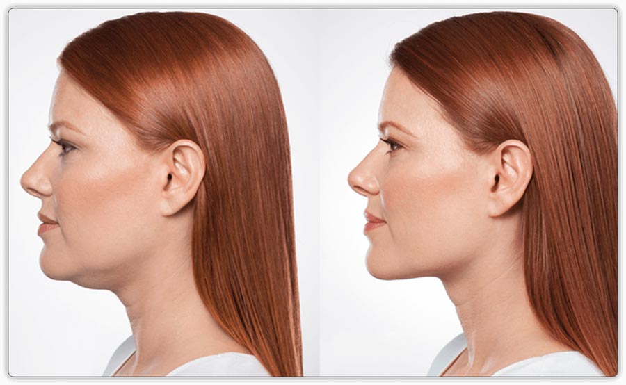 Kybella (Belkyra) or Liquid Lipo