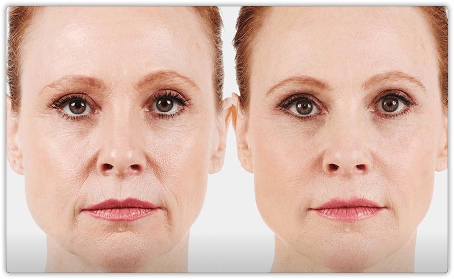Dermal Fillers