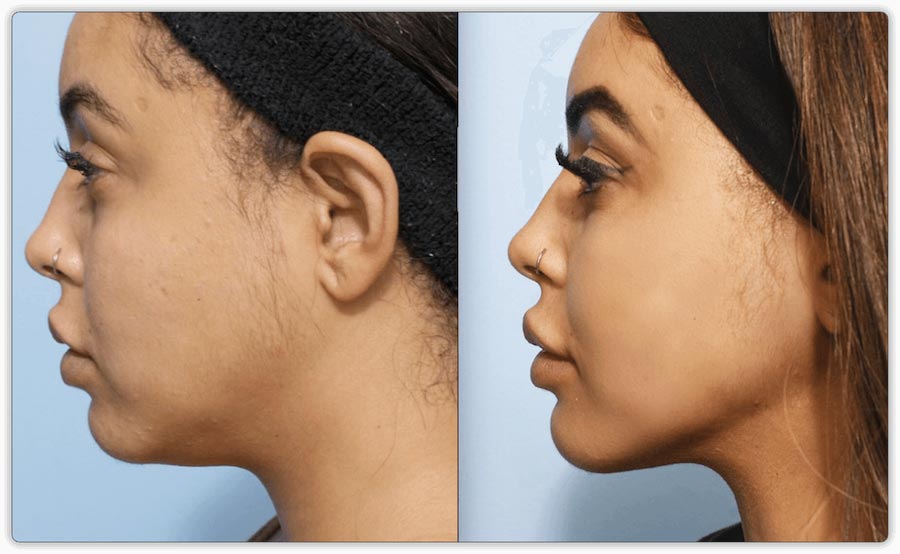 Kybella (Belkyra) or Liquid Lipo