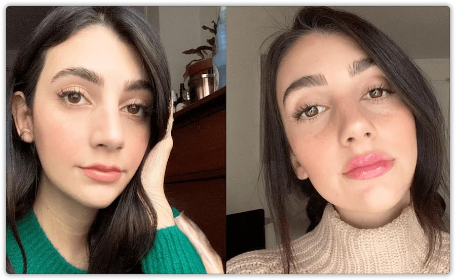 Before and After Lip Fillers