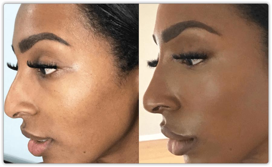 Non Surgical Nose Job