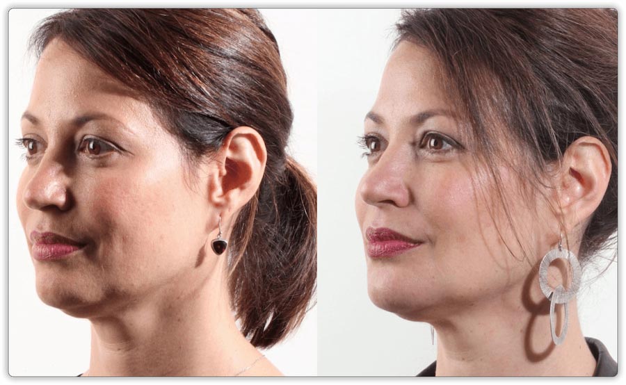 Before and After