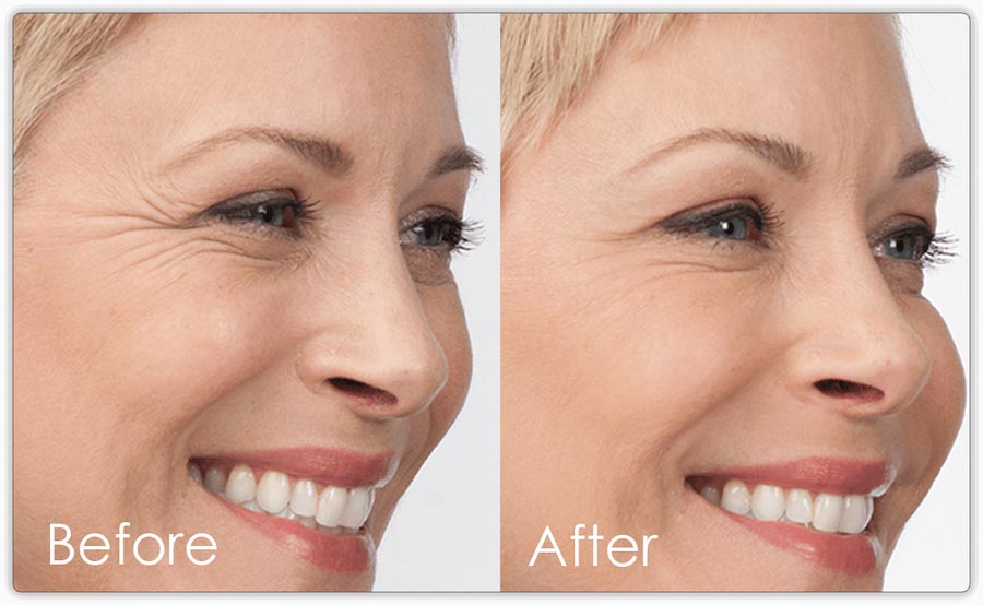 Before and after