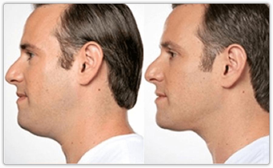 Kybella (Belkyra) or Liquid Lipo