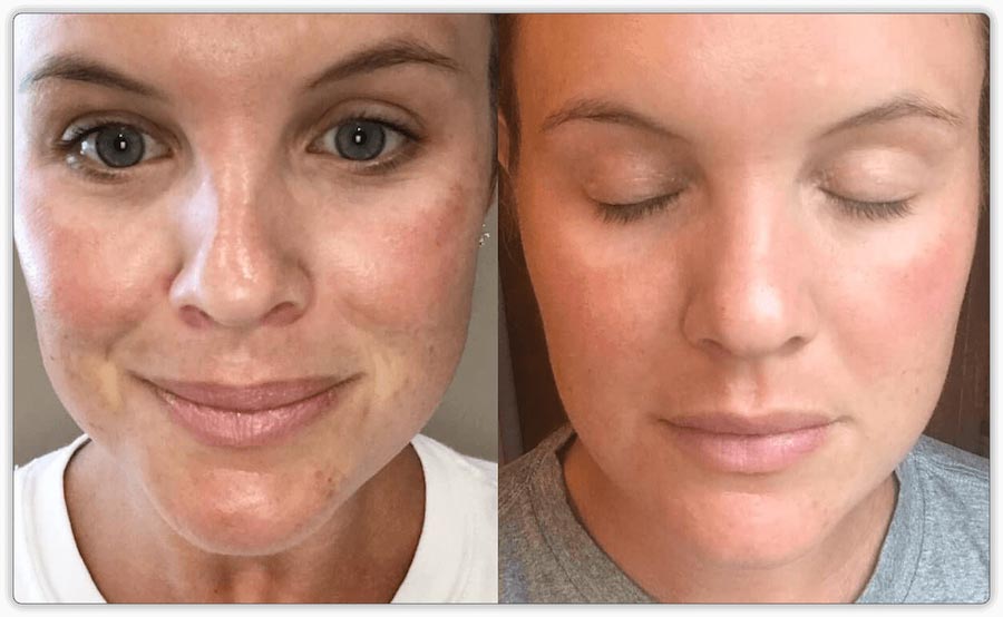 PRP Treatments & Micro-needling